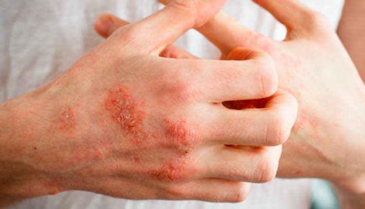 افزایش ابتلا به اگزما در افراد دارای پوست خشک در فصل سرما