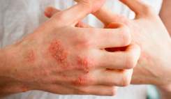 افزایش ابتلا به اگزما در افراد دارای پوست خشک در فصل سرما