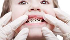 کودکان ایرانی تا 12 سال به طور متوسط 5 دندان دارند