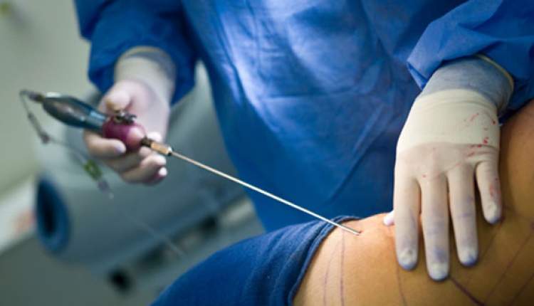 انجام جراحی‌های زیبایی به ویژه لیپوساکشن در مطب‌ها ممنوع است