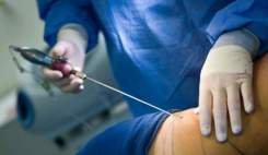 انجام جراحی‌های زیبایی به ویژه لیپوساکشن در مطب‌ها ممنوع است