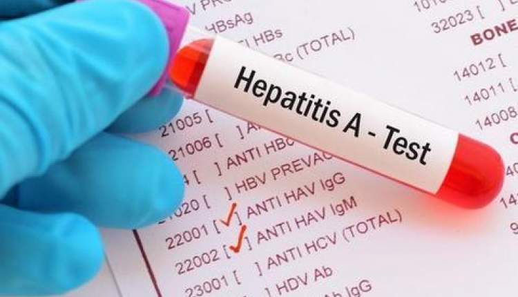 افزایش ۳۰۰ درصدی مبتلایان به هپاتیت A در آمریکا