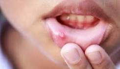 مصرف دخانیات سرطان لب دهان گونه و لثه به دنبال دارد