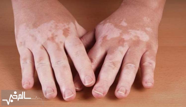 عامل 30 درصد از بروز بیماری پوستی لک و پیس ژنتیکی است