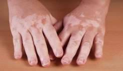 عامل 30 درصد از بروز بیماری پوستی لک و پیس ژنتیکی است