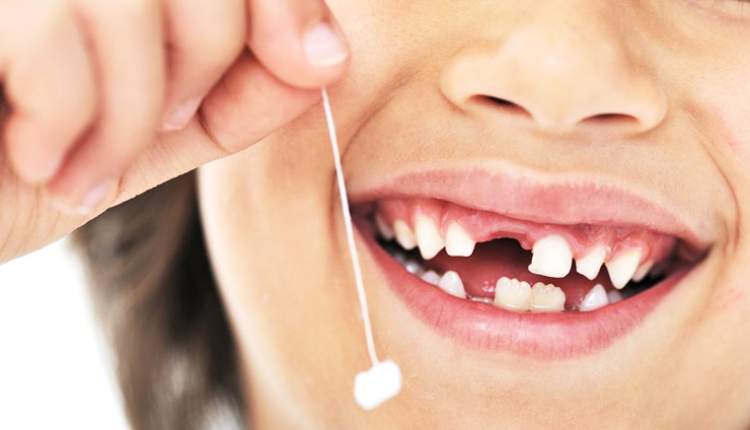 دندان‌های شیری کودکان بدون دلیل نباید کشیده شود