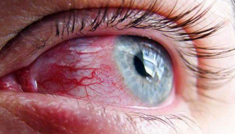 انعکاس آلزایمر در رگ‌های خونی چشم