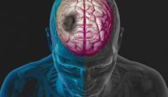 سکته مغزی تا سه ساعت قابل درمان است
