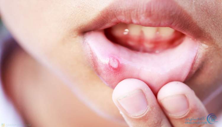 زخم‌ها و ضایعات طول کشنده در حفره دهان را جدی بگیرید