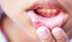 زخم‌ها و ضایعات طول کشنده در حفره دهان را جدی بگیرید