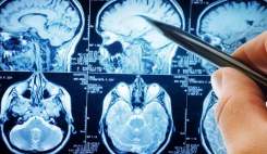 سالانه ۱۸۰ هزار نفر در کشور دچار سکته مغزی می‌شوند