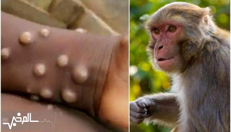 سازمان جهانی بهداشت برای مقابله با آبله میمون هشدار داد