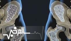 بیش از ۴۲ درصد ایرانیان پوکی استخوان دارند