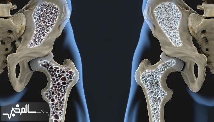 ۴۶ درصد زنان بالای ۵۰ سال پوکی استخوان دارند