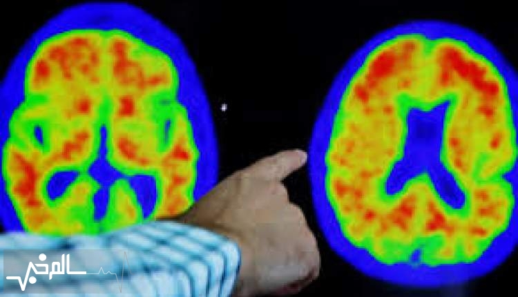 آلزایمر ناشی از نارسایی‌های مغز، کبد و روده است