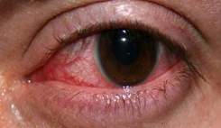 عوامل موثر در بروز سرطان‌های چشم و فرسودگی شبکیه