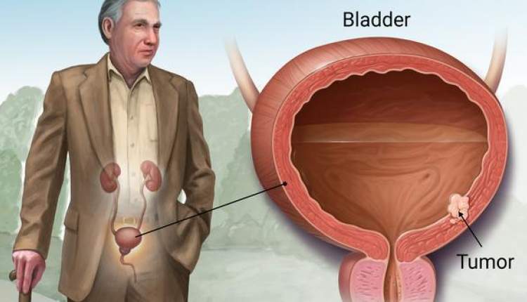 دود تنباکو و توتون عامل بروز سرطان مثانه است
