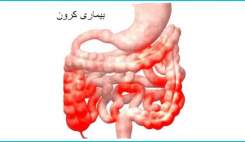 بیماری التهاب روده ریسک مرگ را افزایش می دهد