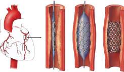 استنت قلبی دچار کمبود است؟
