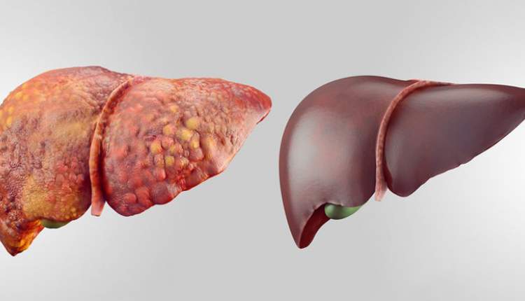 کبد چرب در کمین مصرف کنندگان بی رویه مکمل های غذایی است