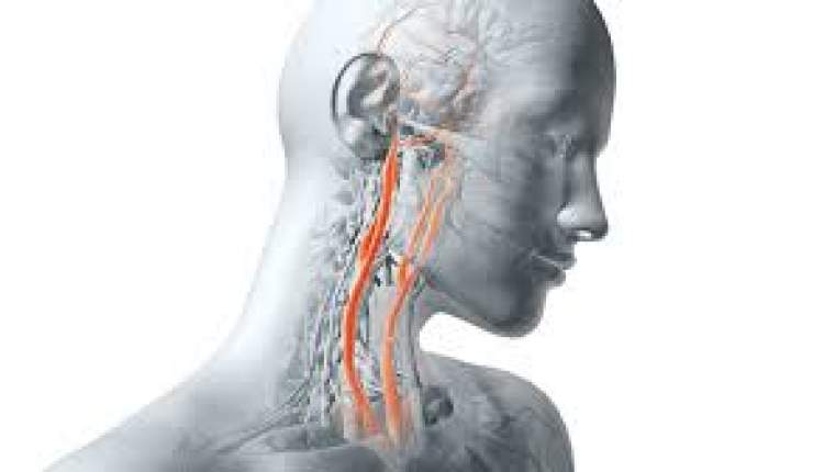 گرفتگی عروق گردن از عوامل مهم بروز سکته مغزی است