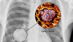 سرطان ریه زنان سیگاری را بیشتر تهدید می‌کند