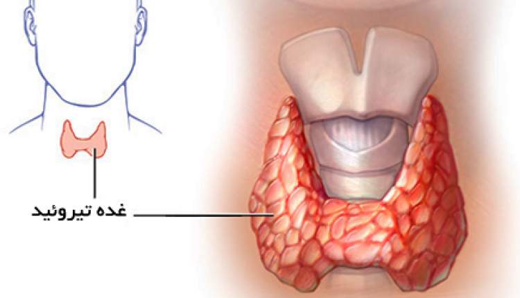 ارتباط بیماری تیروئید با ناباروری