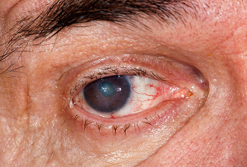 رنگ چشم ها و آب مروارید Cataracts