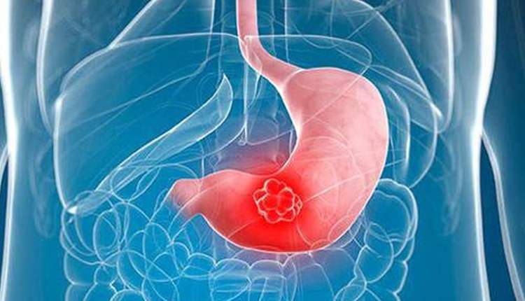 استان‌هایی که صدر ابتلا به سرطان معده قرار دارند