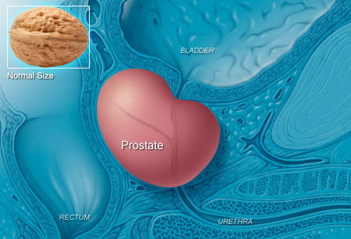 بزرگی پروستات  یا سرطان پروستات؟