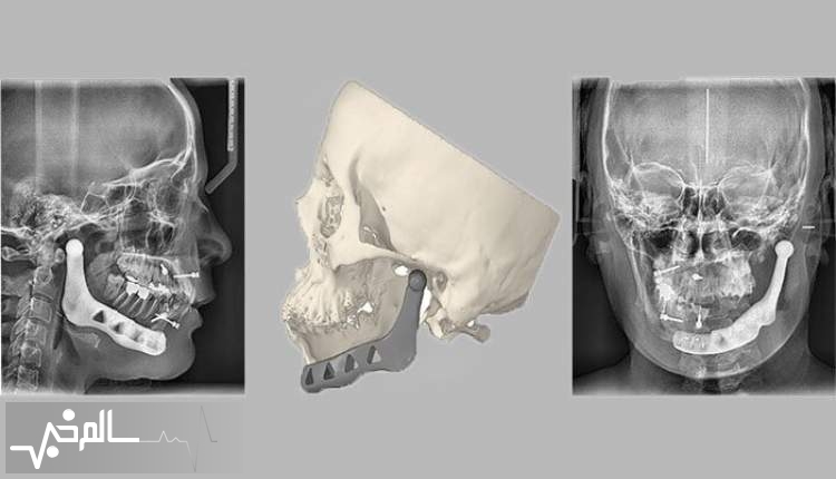 دستگاه تولید گایدهای جراحی فک و صورت در ایران ساخته شد