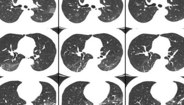 سی تی اسکن ریه فقط برای بیماران کرونایی با شرایط حاد انجام شود