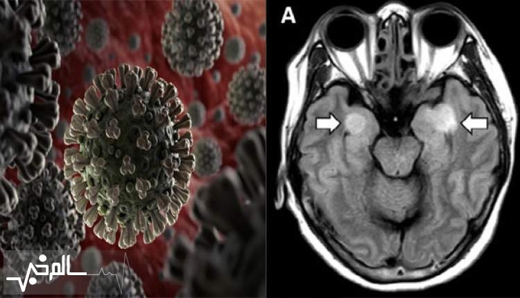 کرونا در برخی مواقع مغز انسان را نشانه می‌گیرد