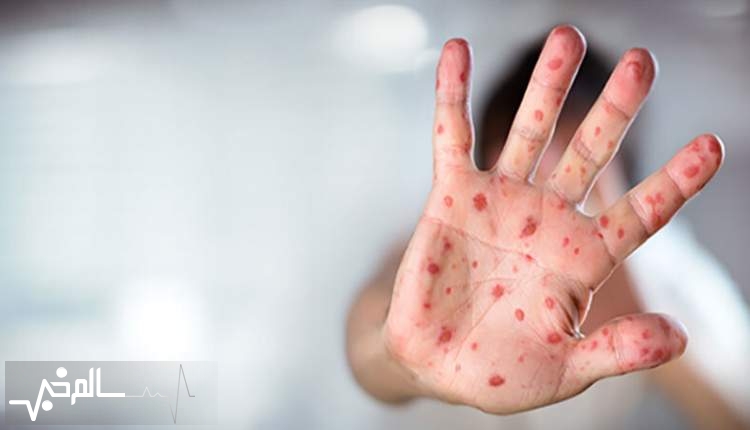 فراخوان اورژانسی برای واکسیناسیون سرخک کودکان ایرانی و غیرایرانی