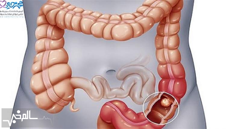 غربالگری قبل از ۵۰ سالگی ریسک سرطان روده را در زنان کاهش می دهد
