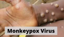 شیوع آبله میمونی در ۱۱ کشور تایید شد
