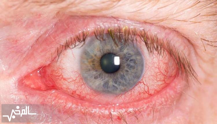 یووئیت شایعترین بیماری چشم که منجر به نابینایی می‌شود