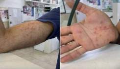 دومین مورد مشکوک به آبله میمون در بابل شناسایی شد