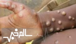 آبله میمون در افراد عادی پس از ۲ تا ۴ هفته بهبود می‌یابد