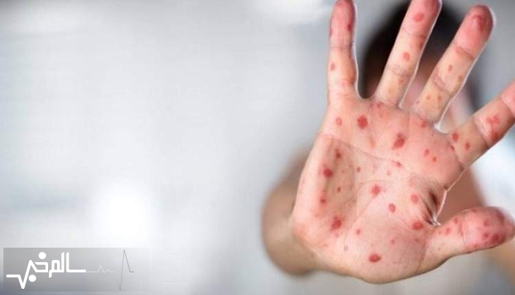 سازمان بهداشت جهانی نام بیماری آبله میمون را به mpox تغییر داد