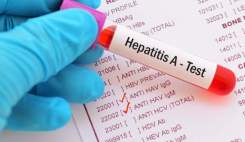 سالانه ۱۲ هزار نفر به هپاتیت A در کشور مبتلا می‌شوند