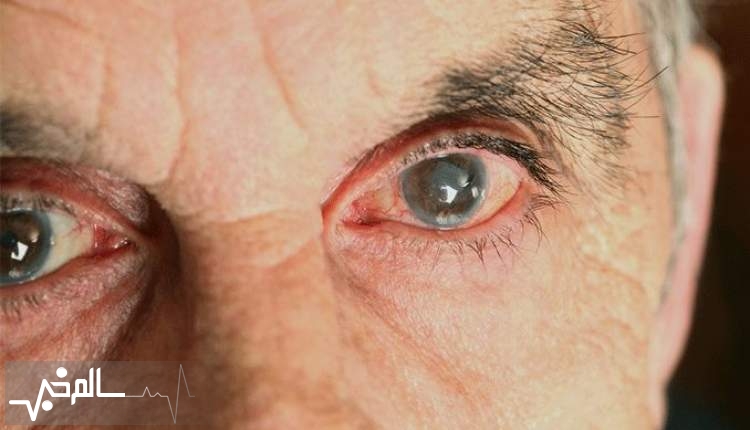 باز هم چشم بیماران جراحی شده برای همیشه خاموش شد
