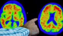 آلزایمر ناشی از نارسایی‌های مغز، کبد و روده است