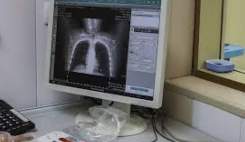 موفقیت درمان فیبروز ریه با استفاده از سلولهای بنیادی در کرمانشاه