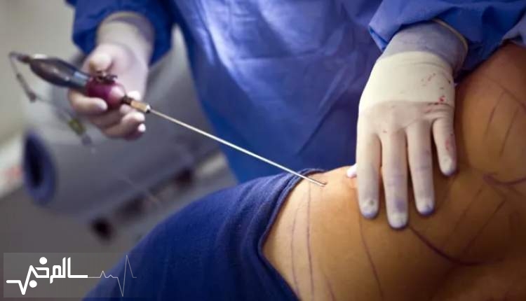لیپوساکشن بیشترین آمار مرگ و میر را در جراحی های زیبایی دارد 