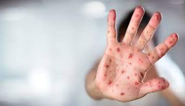 زنگ خطر شیوع «سرخک» به صدا در آمد