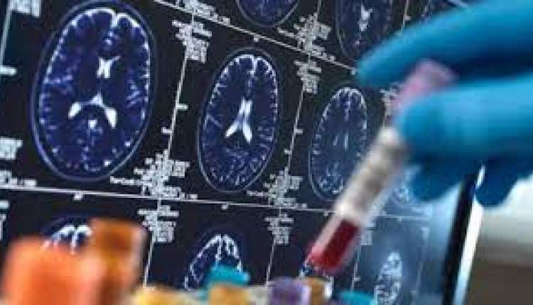 امید تازه در درمان آلزایمر؛ تازه‌ترین داروها تا پایان ۲۰۲۵ ظهور پیدا می‌کنند