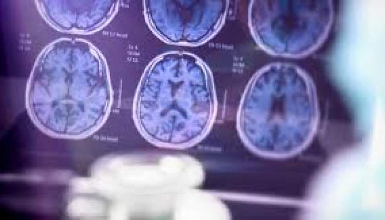 ساعت پیری مغز شما چند است؟ یک MRI از مغز خطر زمان دمانس و آلزایمر را مشخص می‌کند
