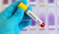 تست خون تشخیص زودهنگام آلزایمر بدون نیاز به اسکن مغز تایید شد