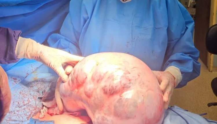 خارج کردن توده ۱۰ کیلویی و ۴۰ سانتیمتری از شکم یک بیمار خارج کردن توده ۱۰ کیلویی و ۴۰ سانتیمتری از شکم یک بیمار